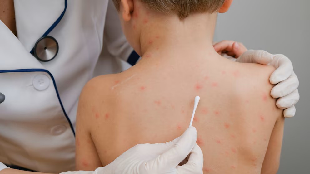 Alerta sanitaria: registran el primer caso de sarampión del año en el país. (Imagen ilustrativa)